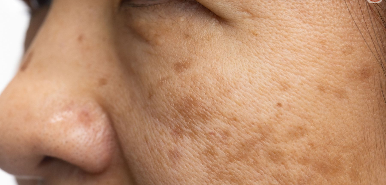 Melasma - przyczyny, objawy i sposoby leczenia