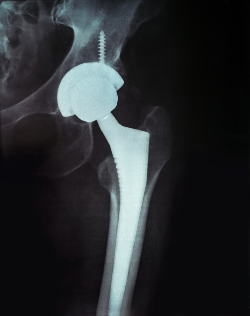 Endoproteza stawu biodrowego - implant stosowany w endoprotezoplastyce przy zaawansowanej koksartrozie