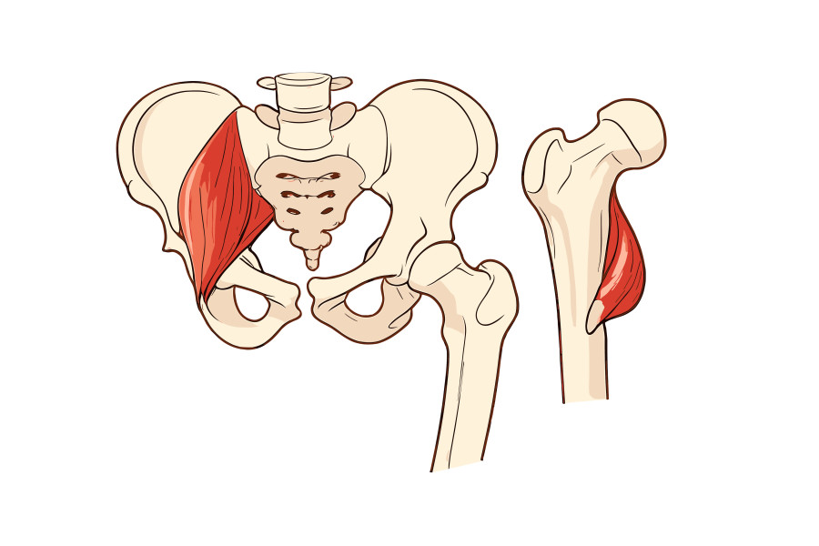Schemat anatomiczny stawu biodrowego z zaznaczonymi zmianami zwyrodnieniowymi chrząstki stawowej